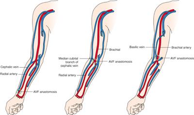 The evolving panorama of vascular access in the 21st century